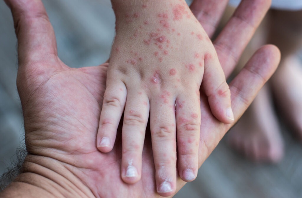 Salud confirma 20 casos de sarampión en Santa Cruz y refuerza medidas para evitar su propagación