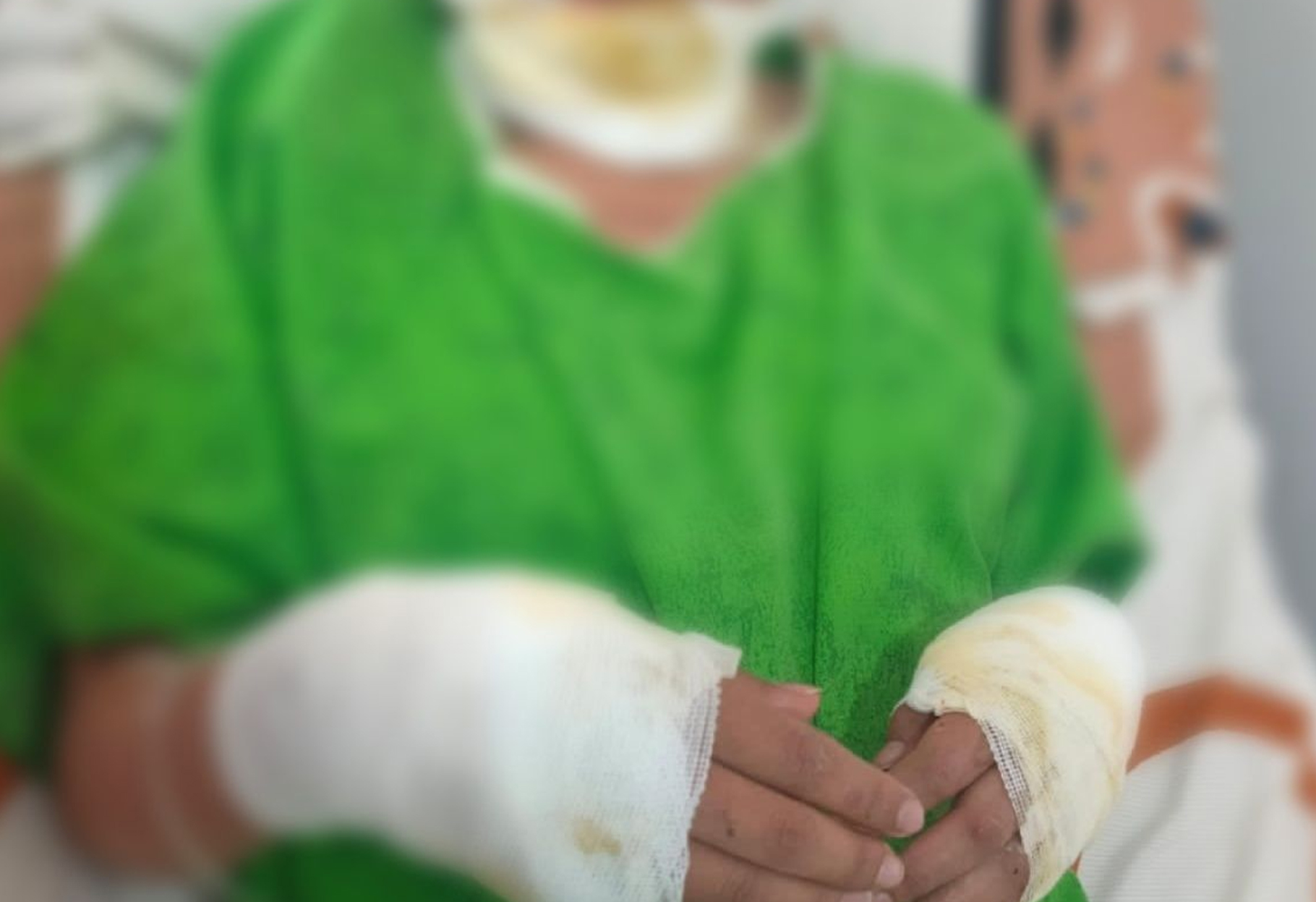 HORROR EN ORURO: PADRES QUEMAN A SU HIJA DE 15 AÑOS Y SON INVESTIGADOS POR TENTATIVA DE FEMINICIDIO